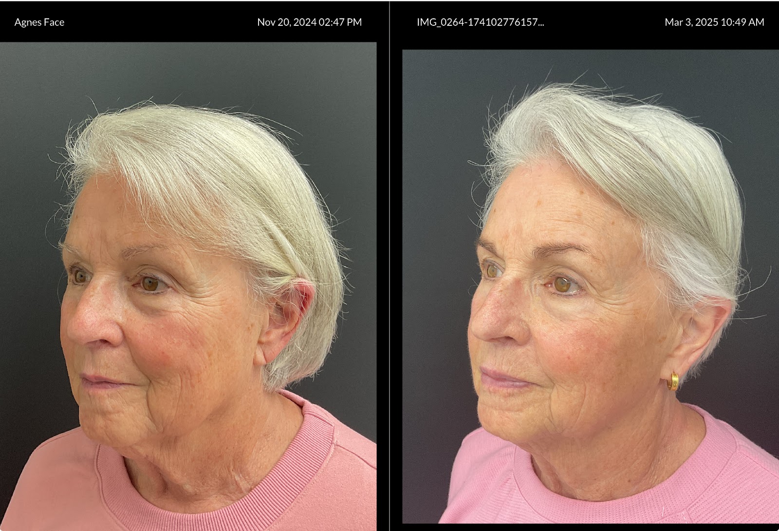 A real Agnes RF skin-tightening before and after at OC Weight Loss & Med Spa